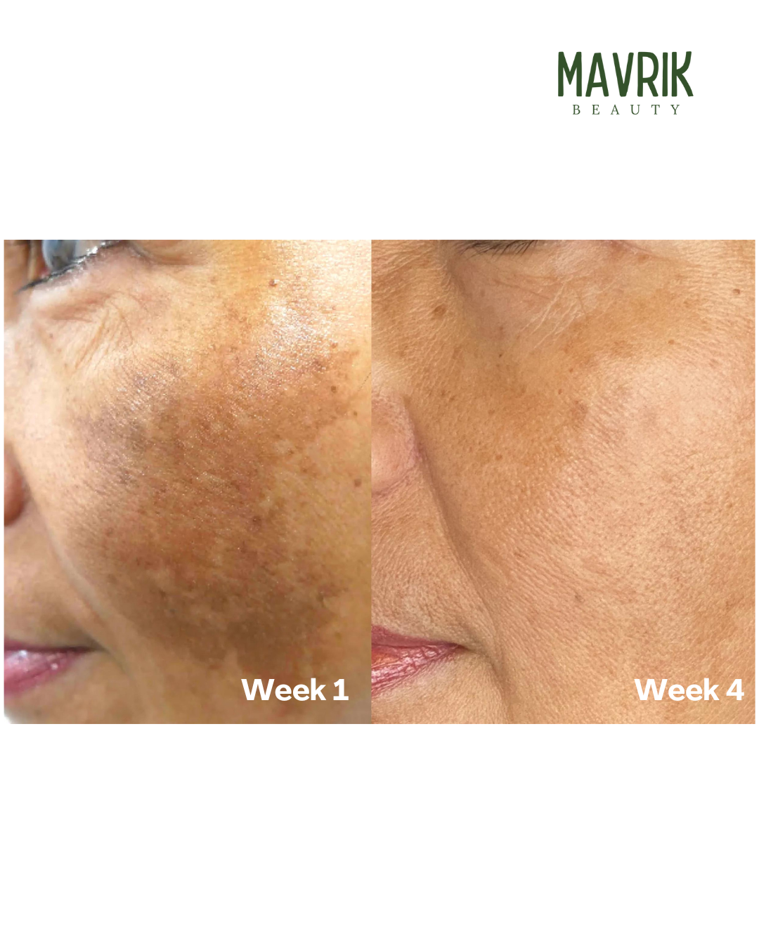 Turmeric & Kojic Acid Soap