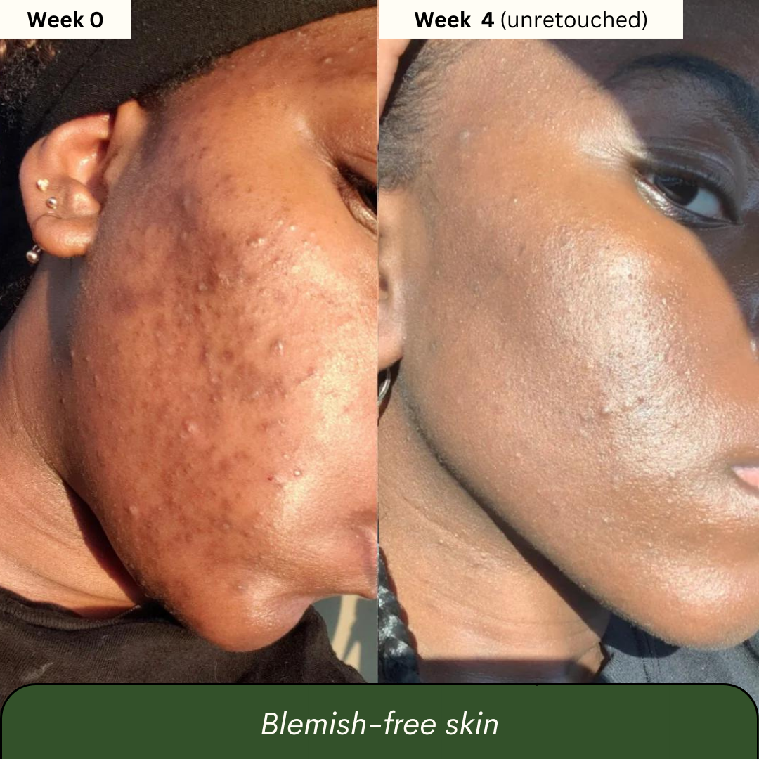 Turmeric & Kojic Acid Soap