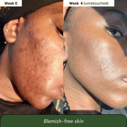 Turmeric & Kojic Acid Soap