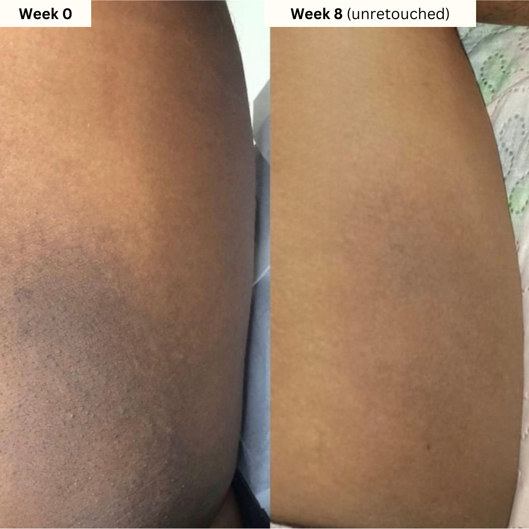 Inner Thigh & Bikini Brightening Kit