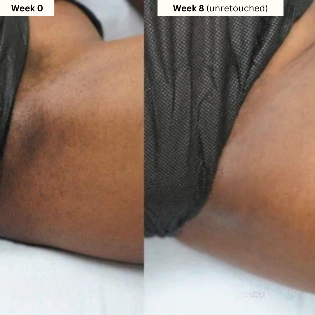 Inner Thigh & Bikini Brightening Kit