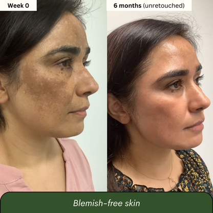 Turmeric & Kojic Acid Soap