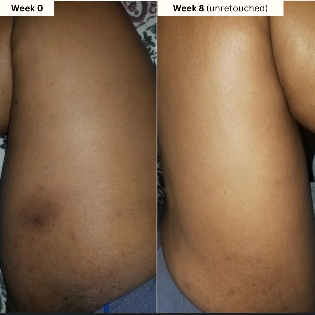 Inner Thigh & Bikini Brightening Kit
