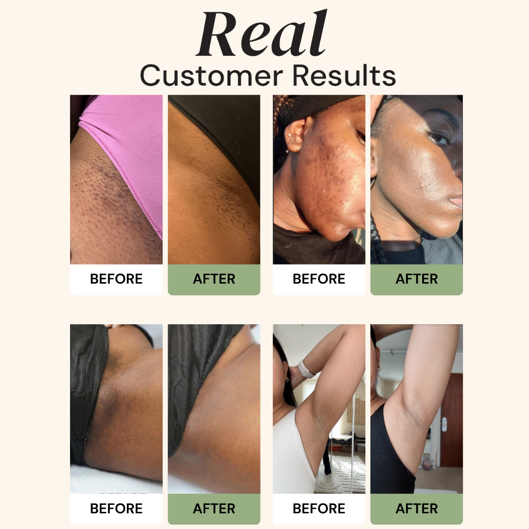 Turmeric & Kojic Acid Soap - Save Up to 50% w/ 3 Free Gifts